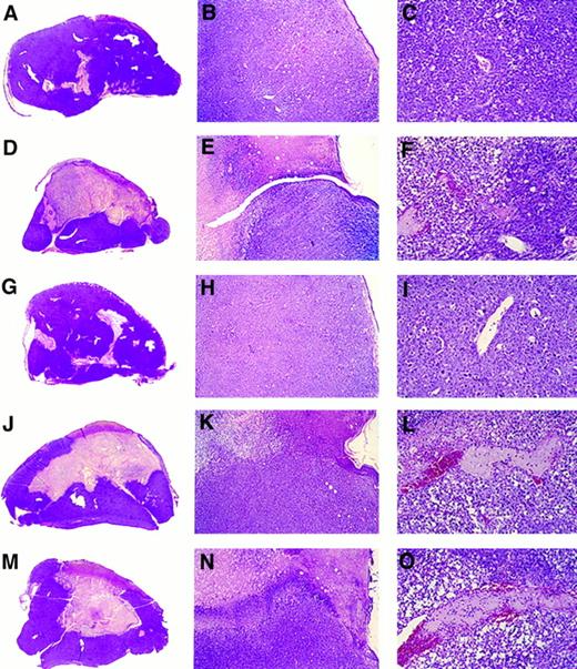 Fig. 3. Gross and microscopic morphology of progressive and regressing BL tumors. Female BALB/c nu/nu 6- to 8-week-old mice were injected subcutaneously with 107 BL cells. After tumor development, mice were observed or injected into the tumor with either LCL, human rMig, or human rIP-10. Tumors were removed in toto 5 to 6 weeks after the initial inoculation and processed for histology. (A through C) Tumor tissue from a mouse injected subcutaneously with CA46 Burkitt's cells. (D through F ) Tissue from a tumor induced by subcutaneous injection with CA46 Burkitt's cells and subsequently injected with LCL (VDS line) weekly for 3 weeks. (G through I) Tissue from a tumor induced by subcutaneous injection with CA46 Burkitt's cells and subsequently injected daily with formulation buffer (0.2 mL into the tumor). (J through L) Tissue from a tumor induced by subcutaneous injection with CA46 Burkitt's cells and subsequently injected daily with human rMig (400 ng/d into the tumor). (M through O) Tissue from a tumor induced by subcutaneous injection with CA46 Burkitt's cells and subsequently injected daily with human IP-10 (400 ng/d into the tumor). (A, D, G, J, and M) Gross morphology of Burkitt's tumors removed in toto with abstract epidermidis and dermis showing in (A) and (G) mostly viable looking tumor tissue with small and patchy areas of necrosis and in (D), (J), and (M) regressing tumors with extensive central necrosis surrounded by viable tumor (no magnification). (B, E, H, K, and N) Microscopic morphology (original magnification ×5) of Burkitt's tumors extending to the epidermidis; in (B) and (H) viable-looking tumor tissue; and in (E), (K), and (N) the abrupt interface between necrotic and viable tumor tissue. (C, F, I, L, and O) Higher power magnification (×20) of viable tumor tissue with patent capillaries (containing red blood cells) in (C) and (I) and capillaries occluded with thrombi at various stages of reorganization in (F ), (L), and (O).