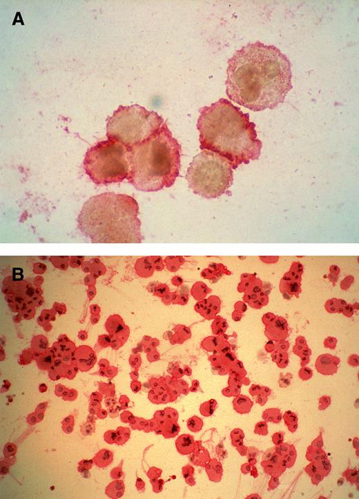Fig. 8. Cytospin preparations of megakaryocytes generated from purified CD34+ cells cultured for 14 days in the presence of MIP-1α, IL-3, IL-6, IL-11, FL, SCF, and MGDF. Most cells displayed a CD61+ phenotype detected by APAAP staining. In (A) cells were treated by BFA and staining was more intense on the cells' surface. Cells in (B) were permeabilized by acetone, and a number of proplatelet structures are visible, together with CD61+ cells with increased ploidy.