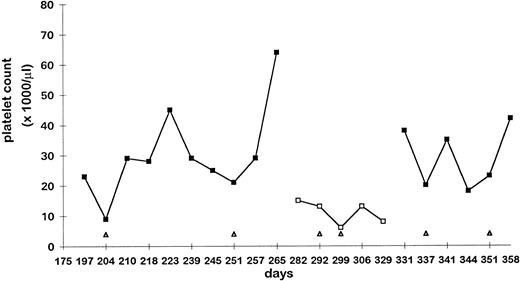 Fig. 2. Patient with HIV-related thrombocytopenia. The y-axis depicts platelet counts (×1,000/μL), whereas the x-axis depicts time (days). (▪) Platelet counts while the patient was receiving AZT; (□) platelet counts off AZT. Anti-D treatments are indicated (▵) along the x-axis. Good responses to anti-D were only seen with concomitant AZT treatment, despite the fact that AZT alone did not improve the platelet count. No difference in hemoglobin decrease after anti-D was seen with the use of AZT (data not shown).