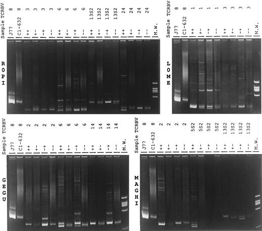 Fig. 2. Heteroduplex analysis of the indicated TCRBV chains PCR products of different T-lymphocyte subsets prepared from the RA patients ROPI, GEGU, LOME, and MAGHI. PCR products obtained from PCR amplification of the cDNA of the J77 and C1-632 cells27 were used as mono and polyclonal controls. ++, CD4+CD57+ T-cell subset; +− CD4+CD57− T-cell subset; −+, CD4−CD57+ T-cell subset; and − −, CD4−CD57− T-cell subset.
