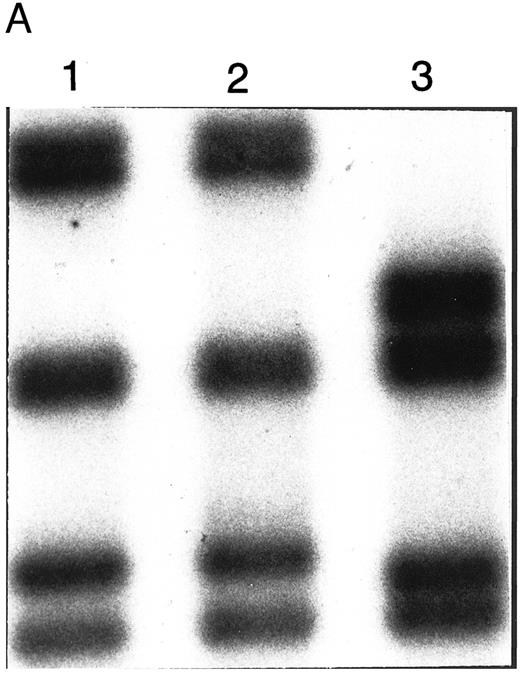 Fig. 1. Analysis of ADA genotype of patient no. 1 and family. (A) SSCP analysis of genomic exon 5. Lanes 1 and 2, controls; lane 3, patient no. 1. (B) Sequencing gel showing heterozygosity of patient no. 1 for the P126Q mutation in genomic exon 5 DNA. (C) Pedigree of family 1. Arrow indicates patient no. 1 (II-1).