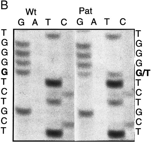 Fig. 1. Analysis of ADA genotype of patient no. 1 and family. (A) SSCP analysis of genomic exon 5. Lanes 1 and 2, controls; lane 3, patient no. 1. (B) Sequencing gel showing heterozygosity of patient no. 1 for the P126Q mutation in genomic exon 5 DNA. (C) Pedigree of family 1. Arrow indicates patient no. 1 (II-1).