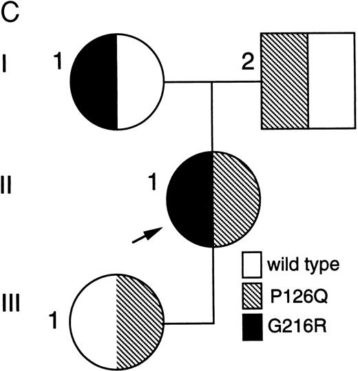 Fig. 1. Analysis of ADA genotype of patient no. 1 and family. (A) SSCP analysis of genomic exon 5. Lanes 1 and 2, controls; lane 3, patient no. 1. (B) Sequencing gel showing heterozygosity of patient no. 1 for the P126Q mutation in genomic exon 5 DNA. (C) Pedigree of family 1. Arrow indicates patient no. 1 (II-1).
