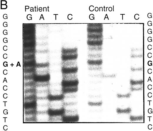 Fig. 2. Analysis of ADA cDNA and genomic DNA of patient no. 2 and family. (A) Pedigree of family 2. Arrow indicates patient no. 2 (II-3); † indicates the deceased proband (III-1), an infant with SCID whose genotype is presumed. (B) Sequence of genomic exon 7 DNA (patient no. 2, left; control, right). Patient no. 2 is heterozygous for the A215T mutation. (C) Ethidium-stained agarose gel illustrating the method of screening cDNA clones for the R101Q mutation and for retention of exon 7 (see the Materials and Methods). Numbers at right indicate length in nucleotides of DNA markers. Lanes 1 and 2, PCR fragments (exons 1 to 8) digested with Bsg I. Lane 1, clone bearing R101Q mutation (cuts with Bsg I); lane 2, clone with wild-type (R101) exon 4 (lacks Bsg I site). Lanes 3 and 4, PCR fragments (exons 5 to 11) digested with Nci I. Lane 3, clone containing exon 7 (cuts with Nci I within exon 7); lane 4, clone with a deletion of exon 7 (lacks exon 7 Nci I site).