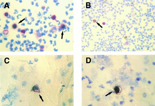 Fig. 1. Cytospin specimens of PBMCs and exfoliated oropharyngeal cells from a human affected by IM. Isotopic EBER ISH (silver grains) was combined with immunocytochemistry (red membrane staining). (A) Two EBER- positive peripheral blood lymphocytes (arrows) expressing the CD45RA antigen detected by MoAb Ki-B3. Original magnification × 630. (B) A single EBER-positive peripheral B lymphocyte (arrow) expressing the CD20 antigen (MoAb L26) and two EBER-positive PBMCs lacking CD20 expression. Original magnification × 250. (C and D) Simultaneous labeling for EBER and CD45RA shows single EBV-infected lymphocytes (arrows) among multiple unlabeled epithelial cells characterized by their broad cytoplasm. Original magnification × 630.