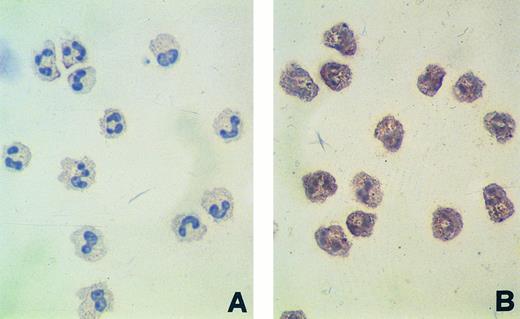 Fig. 3. Constitutive expression of RET protein in purified human normal neutrophils, as detected by immunocytochemistry (A and B), and in CD14+ PB monocytes, as detected by Western blotting (C). (A) Neutrophils stained with affinity-purified nonimmune rabbit serum (0.1 μg/mL). (B) Neutrophils stained with affinity-purified rabbit polyclonal antibodies recognizing the RET tyrosine-kinase domain (0.1 μg/mL). Original magnification for (A) and (B) × 400. (C) Western blot analysis of RET protein in human normal monocytes. Proteins extracted from purified CD14+ PB monocytes, THP-1 (positive control), and undifferentiated U937 (negative control) cell lines were immunoprecipitated with two antibodies (Ab 1 and Ab 2) recognizing different cytoplasmic domains the RET RTK, blotted onto immobilon-P membranes, and shown by standard chemiluminescence.