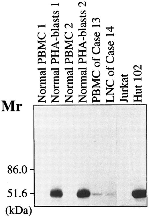 Fig. 2. Cell lysates of fresh PBMC and PHA-stimulated PBMC (PHA-blasts, on day 3) from two donors, PBMC from case no. 13, LN cells from case no. 14, Jurkat, and Hut102 were mixed with SDS sample buffer, boiled for 5 minutes, and then applied to electrophoresis through a 7.5% polyacrylamide gel. Proteins were transferred to a sheet of PVDF membrane and the membrane was incubated with 10 μg/mL 315 MoAb. The binding of the MoAb was detected as described in Materials and Methods.