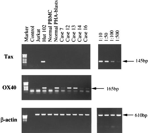 Fig. 3. Total cellular RNA was isolated by the acid-guanidium thiocyanate-phenol-chloroform method from Jurkat, Hut102, normal PBMC, normal PHA-blasts, and from PBMC or LN cells of five ATL cases. Single-strand cDNA synthesis and subsequent PCR reaction was done as described in Materials and Methods. PCR products were electrophoresed through 1.5% agarose gel, stained with ethidium bromide, and visualized on a UV-transilluminator. On the right, dilutions indicate the ratios of Hut102 cells to Jurkat cells.