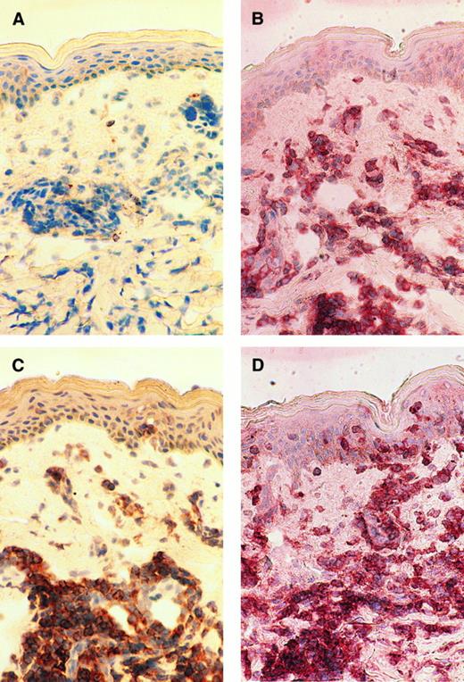 Fig. 5. Immunohistochemical findings of the skin biopsy from case no. 9. The serial cryostat sections of skin biopsy specimens fixed in acetone were stained with control mouse IgG (A), OKT4 (B), anti-Tac (C), and 315 MoAb (D). Mononuclear cells infiltrating into upper dermis are clearly positive for CD4, Tac (IL-2 receptor α), and OX40.