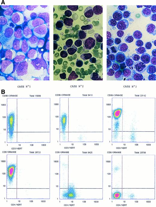Fig. 1. Morphological studies of pathologicals specimens. (A) Imprint of the three cases of NK-NHL. Case no. 1: Large blastic lymphoid cells looked like immunoblasts with a high mitotic rate (MGG, original magnification × 3,300). Case no. 2: Medium lymphoid cells with irregular nuclei and fine chromatin (MGG, original magnification × 3,300). Case no. 3: Medium and large lymphoid cells with vacuoles and azurophilic granules in the cytoplasm (MGG, original magnification × 3,300). (B) Immunophenotypic analysis. Coexpression study of CD3 and CD56 in the three cases found the unique tumoral phenotype CD3− CD56+. Heterogeneity is described concerning CD4 and CD8 expression. Case no. 1: CD4−CD8+; Case no. 2: CD4+CD8−; Case no. 3: CD4−CD8−.