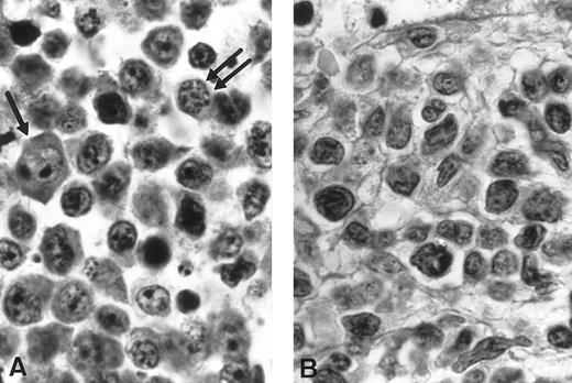 Fig. 2. Histological findings (cases no. 1 and 2). (A) Case no. 1: High-grade T-cell lymphoma, large cell predominance; proliferation of large lymphoid cells with immunoblasts (arrow) and medium-sized cells with plasmacytic differentiation (double arrow). Notice the discrete nuclear pleomorphism (hematoxylin-eosin, original magnification × 1,320). (B) Case no. 2: High grade pleomorphic T-cell lymphoma, medium-sized and large cell predominance. Proliferation of lymphoid cells with irregularly indented nuclei of various size and small nucleoli looking like a pleomorphic T-cell lymphoma with predominance of medium cells (hematoxylin-eosin, original magnification × 1,320).