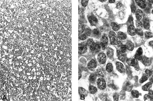 Fig. 3. Histological findings (Case 3). (A) Diffuse infiltration, high-grade pleomorphic T-cell lymphomas of medium-sized cell predominance with numerous histiocytes showing a “starry-sky” pattern (hematoxylin-eosin, original magnification × 660). (B) The cells exhibit round or oval irregular nuclei with marked clumped chromatin and one distinct nucleoli (hematoxylin-eosin, original magnification × 1,320).