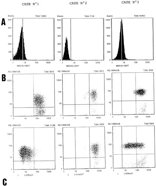 Fig. 4. MDR expression. (A) P-glycoprotein expression on tumoral cells in the three cases according to MRK16 staining. Vertical solid lines show the limits of the isotype control IgG2a. (B) Efflux of Rh123 in dual fluorescence assay with PE-labeled CD56 MoAb (vertical axis). After rhodamine uptake cells were incubated in a dye-free medium at 37°C with (first graph) or without verapamil (second graph). Green rhodamine fluorescence (horizontal axis) is diminished at 37°C without verapamil in cases no. 1 and 3. (C) MDR1 mRNA is analyzed using RT-PCR with 31 cycles. Lane 1, sensitive K562 c-DNA; lane 2, resistant K562 R7 c-DNA; lanes 3, 4, and 5 refer to patient nos. 1, 2, and 3, respectively. β-μG, β2-microglobulin.