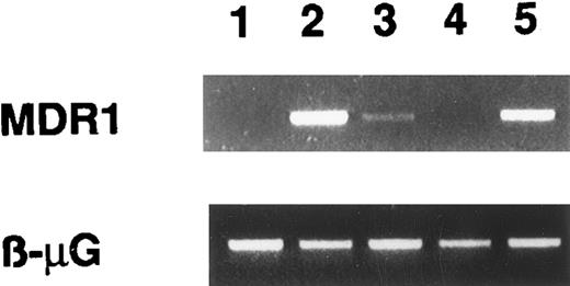 Fig. 4. MDR expression. (A) P-glycoprotein expression on tumoral cells in the three cases according to MRK16 staining. Vertical solid lines show the limits of the isotype control IgG2a. (B) Efflux of Rh123 in dual fluorescence assay with PE-labeled CD56 MoAb (vertical axis). After rhodamine uptake cells were incubated in a dye-free medium at 37°C with (first graph) or without verapamil (second graph). Green rhodamine fluorescence (horizontal axis) is diminished at 37°C without verapamil in cases no. 1 and 3. (C) MDR1 mRNA is analyzed using RT-PCR with 31 cycles. Lane 1, sensitive K562 c-DNA; lane 2, resistant K562 R7 c-DNA; lanes 3, 4, and 5 refer to patient nos. 1, 2, and 3, respectively. β-μG, β2-microglobulin.