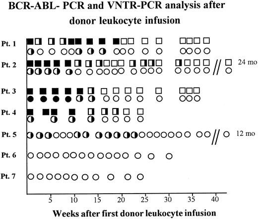 Fig. 2. BCR-ABL-positivity and chimerism analyzed in PB of five patients relapsing after BMT receiving donor leukocyte infusions. BCR-ABL-PCR of PB samples: (▪), one-step-positivity: one leukemic cell in 104 cells; (╞), two-step-positivity: one leukemic cell in 106 cells; (□), BCR-ABL-PCR-negativity with less than one leukemic cell in 106 cells. VNTR-PCR of PB samples: (•), recipient banding in VNTR-PCR; (◑), chimerism demonstrated by donor and recipient banding in VNTR-PCR; (○), donor banding in VNTR-PCR.