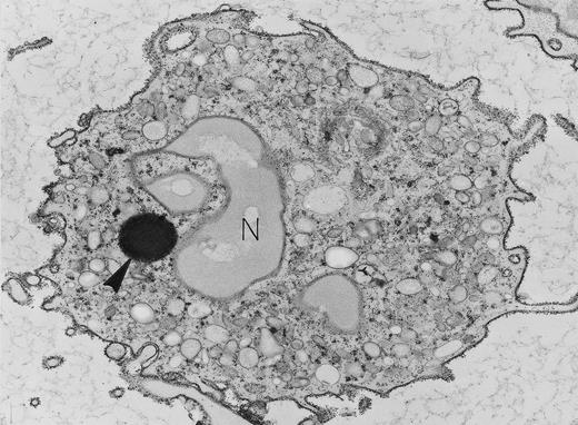 Neutrophil with lipid body. Specialized ultrastructural procedures were used to image this peripheral blood neutrophil. A reduced osmium postfixation step renders nuclear lobes (N) and secretory granules poorly electron-dense but each individual particle of cytoplasmic glycogen is electron-dense, and the single, large, round, membrane-free lipid body (arrowhead) is highly electron-dense. Exposure to cationized ferritin after fixation has provided a uniform layer of electron-dense ferritin particles bound to the plasma membrane. Original magnification × 8,000. (Courtesy of Ann M. Dvorak, MD, Department of Pathology, Beth Israel Hospital, Harvard Medical School, 330 Brookline Ave, Boston, MA 02215.)