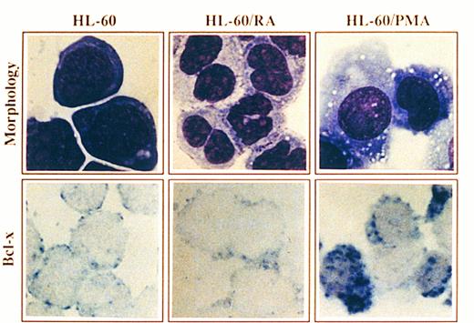 Fig. 4. Morphology and Bcl-x expression in HL-60 cells treated with PMA or RA. HL-60 cells untreated or after culturing in the presence of PMA for 4 days or RA for 6 days were cytocentrifuged and either stained with May-Grunwald-Giemsa solution or analyzed for the expression of Bcl-x using a rabbit anti–-Bcl-x antibody. After incubation with biotinilated goat antirabbit IgG and ExtrAvidin alkaline phosphatase, staining was developed using BCIP/NBT substrate (original magnification × 1,000). No signal was detectable in the negative controls. All stainings are from a representative experiment (n = 3).
