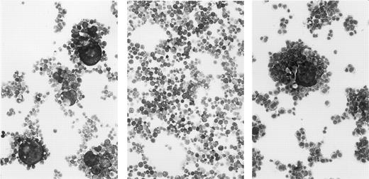 Fig. 5. Syncytium formation by HTLV-I–infected T-cell clones. The clones Du4 (left), Du26 (center), and Mu16 (right) were incubated overnight with C8166-45 indicator cells, cytospun, fixed, and stained with Giemsa.