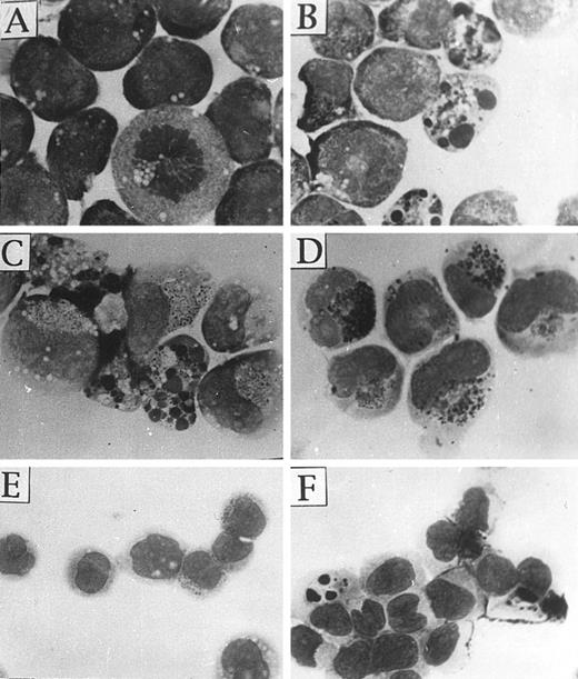 Fig. 2. As2O3 induces morphological changes in cultured primary APL cells and NB4 cells. (A through D): NB4 cells were treated without (A) and with 1 μmol/L (B) As2O3 for 24 hours, and 0.5 (C) and 0.1 μmol/L (D) As2O3 for 10 days; (E and F): BM cells from one relapsed APL patient were cultured and treated in vitro without (E) and with (F ) 2 μmol/L As2O3 for 24 hours. Similar results were also observed in three other APL cases. Cells were centrifuged onto slides by cytospin (Shandon, 500 rpm, 4 minutes) and stained with Wright's staining.