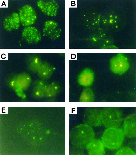 Fig. 5. Immuno-fluorescence analysis of the subcellular localization of PML-RARα/PML in cultured primary APL cells from a patient. (A) Control; (B) 1 μmol/L As2O3 treatment for 12 hours; (C) 1 μmol/L As2O3 treatment for 24 hours. (D) One micromolar As2O3 treatment for 48 hours; (E) 0.1 μmol/L 1 μmol/L As2O3 treatment for 24 hours; (F ) in vivo BM cells on day 15 of treatment.