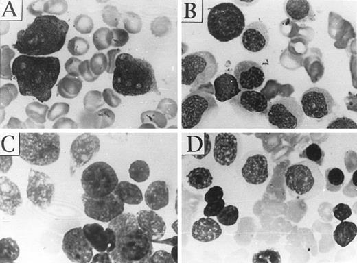 Fig. 7. In vivo BM cell morphologic changes in an APL patient during continuous As2O3 treatment. (A) Promyelocytic leukemic cells before the treatment; (B) myelocyte-like cells on day 21 of treatment; (C and D) “nude nuclear” cells with coarse (C) or condensed (D) nuclei on day 28 of the treatment. Similar changes also appeared in peripheral blood (not shown).