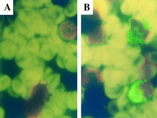 Fig. 9. In situ TdT labeling of BM smear from an APL patient. (A) Before the treatment; (B) on day 24 of As2O3 treatment. Similar results were seen in another patient.