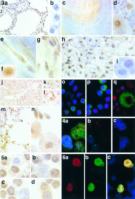 Fig. 3. Immunostaining of human tissues and tonsil cell preparations using anti-HRX antibodies. (a) Antibody HRX 107 labels all nuclei in the thyroid gland in a punctate nuclear pattern. The pattern of labeling can be seen more clearly at high power (b). (c) MoAb HRX 107 labels most nuclei in the cerebellum in a punctate nuclear pattern, although the intensity of labeling varies from cell to cell. Again the pattern of labeling can be seen more clearly at high power, particularly the nuclear labeling of Purkinje cells (d). (e and f ) The punctate distribution of HRX in nuclei of cardiac myocytes found with MoAb HRX 107 which is comparable to the pattern of labeling with polyclonal antibody αHRX2 (g). (h) Labeling of nuclei in the glomerulus of kidney with MoAb HRX 107; the punctate pattern of distribution being clearly visible at high power (i). (j) Labeling of liver with polyclonal antibody αHRX2 and at high power (k), compared with MoAb HRX 107 (l). (m and n) Labeling of lung with polyclonal antibody αHRX2. (o) MoAb HRX 107 (red) labeling T cells (green). (p) MoAb HRX 107 (red) labeling B cells (green). (q) MoAb HRX 107 (red) labeling a macrophage cell (green). / Fig 4. Comparison of HRX with other known transcription factors that exhibit punctate nuclear staining. (a) MoAb HRX107 (red) and anti-TAL-1 (green) on the Jurkat cell line. (b) MoAb HRX107 (red) and anti-PML (green) on tonsil cell cytospins. (c) MoAb HRX107 (red) and anti-PML (green) on the NB4 cell line. / Fig 5. Comparison of MoAb HRX 107 and polyclonal antibody αHRX2 on cell lines. MoAb on U937 (a) and RS4; 11 (c). Polyclonal antibody on U937 (b) and RS4; 11 (d). / Fig 6. (a) Immunofluorescent labeling of Bosc 293 cells transfected with a flag-tagged HRX-ENL expression construct under control of the early CMV promoter and enhancer using MoAb HRX 107. (b) Immunofluorescent labeling of the same cells illustrated in 4a with the antiflag antibody. (c) Colocalization of MoAb HRX 107 and the antiflag antibody on the same cells illustrated in 4a and 4b. The untransfected cells (blue) can clearly be seen.