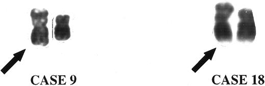 Fig. 2. Partial karyotype of metaphase cells showing the der(8)t(8; 17)(p11; q11). The der(8) chromosomes are identified with arrows.