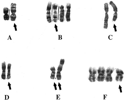 Fig. 3. Partial karyotypes of metaphase cells showing abnormalities involving the short arm of chromosome 1. The rearranged chromosome 1 homologs are identified with arrows. (A) Case 9, add(1)(p36); (B) case 10, t(1; 4)(p33; p16); (C) case 14, add(1)(p36) and ins(1:?)(q?25; ?); (D) case 15, del(1)((p34p35)); (E) case 16, del(1)(p?32p35) and add(1)(p33); (F ) case 18, del(1)(p33).