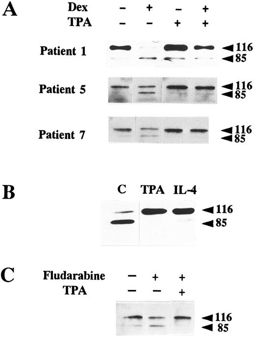 Fig. 3. Inhibition of PARP proteolysis by TPA and IL-4. (A) Inhibition of dexamethasone-induced PARP proteolysis by TPA. B-CLL lymphocytes from three patients were incubated with 100 nmol/L TPA in the presence or absence of 10 μmol/L dexamethasone for 48 hours. (B) Inhibition of spontaneous PARP proteolysis. Cells from patient 6 were incubated for 48 hours either in the absence of any factor (C) or with 100 nmol/L TPA, or IL-4 (10 ng/mL). (C) Inhibition of fludarabine-induced PARP cleavage. Cells from patient 5 were incubated with the indicated factors for 24 hours. The concentrations used were 100 nmol/L TPA and 5 μg/mL fludarabine. Western blot of PARP was performed with protein extracts from these cells as previously described.
