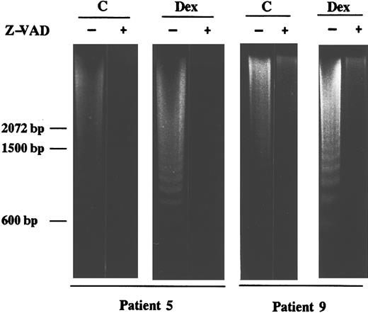 Fig. 5. Effect of the CED-3/ICE–like protease inhibitor Z-VAD.fmk on DNA fragmentation in B-CLL cells. Cells from patients 5 and 9 were incubated for 24 hours with 10 μmol/L dexamethasone in the presence or absence of 200 μmol/L Z-VAD.fmk. Z-VAD.fmk was added 1 hour before dexamethasone administration. DNA was extracted and subjected to agarose gel electrophoresis as described in Materials and Methods. Similar results were obtained with cells from patients 7 and 8.