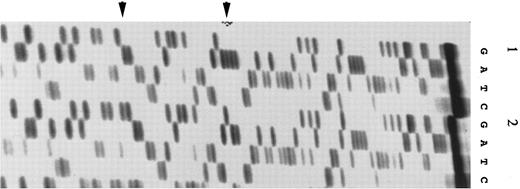 Fig. 4. Mutations 3 and 4 in exon 5 of PIG-A found in marrow hematopoietic progenitor cells. (1) A G to T transversion (mutation 3) indicated by the left arrow; (2) a 2-bp (AA) deletion (mutation 4) indicated by the right arrow.