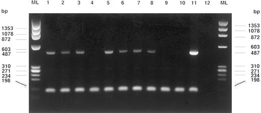 Fig. 1. WT1 gene (487 bp) and cABL gene (198 bp, control of RNA-integrity) RT-PCR amplification products of fetal blood MNCs and different single soft agar colonies are shown on an electrophoresis gel stained with ethidium bromide. Lanes from left: Fetal blood MNCs from patients S.M. (1), K.B. (2), and K.Z. (3), MNCs from the leukapheresis product of a solid cancer patient treated with stem cell-mobilizing chemotherapy and G-CSF4, colonies at day 14: CFU-GEMM (5), BFU-E (6), CFU-E (7), CFU-GEMM (8), colonies at day 21: BFU-E (9), CFU-GM (10), HL60 cells (11, positive control), water control (12), and marker lanes (ML).