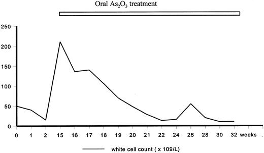 Fig. 1. A 30-year-old man presented in March 1954 with splenomegaly and CML in chronic phase was diagnosed. No specific treatment was given until October 1954 when his splenomegaly increased to 5 cm and his white cell count increased to 50 × 109/L. Fowler's solution 5 minims (1 minim = 0.06 mL, equivalent to 0.6 mg As2O3 ) three times daily was administered, resulting in a satisfactory control of his white cell count to about 10 × 109/L. Treatment was stopped. Six months later, he was readmitted with progressive splenomegaly (10 cm) and leucocytosis (211 × 109/L). Fowler's solution was recommenced at 5 minims three times daily, and increased to 10 minims three times daily. This resulted in gradual control of his white cell count. The dose of As2O3 was decreased to a maintenance dose of 5 minims three times daily. However, 8 months later, signs and symptoms of chronic arsenic poisoning developed, including skin pigmentation, diarrhea, and chronic gastrointestinal hemorrhage. As2O3 was stopped and he was put on melphalan. Splenomegaly and leucocytosis progressed despite treatment, and he died 11 months later of pneumonia. The maximum daily dose (10 minims × 3) of As2O3 given orally was 18 mg, which is comparable to 10 mg/d when used intravenously for the treatment of relapsed APL.