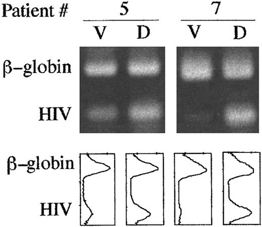 Fig. 3. Viral DNA is enriched in dead cells from HIV-infected lymph nodes. Viable (V) and dead (D) cells were purified by density gradient centrifugation as described in Materials and Methods. HIV and β-globin DNA sequences were co-amplified by PCR in 1,000 cells from each population. Upper panels show ethidium bromide-stained amplification products separated in agarose gel. Comparison of the relative intensities of β-globin–specific and HIV-specific bands by densitometric scanning (lower panels) revealed that HIV genomes in the dead cell populations from patients 5 and 7 were, respectively, ∼5 and <30 times more abundant than in the corresponding viable populations.