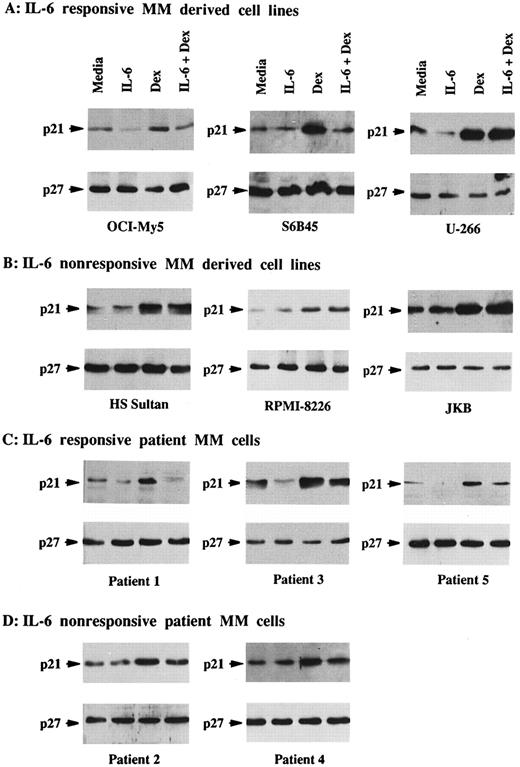 Fig. 2. Effects of Dex and/or IL-6 on p21 protein expression in MM cell lines and patient MM cells. Cells (2 × 105/mL) from IL-6–responsive MM-derived cell lines (OCI-My5, S6B45, and U-266; A) and IL-6–nonresponsive MM cell lines (HS Sultan and RPMI-8226) and JKB ALL cell line (B); 1 × 106/mL IL-6–responsive patient MM cells (patients no. 1, 3, and 5; C) and IL-6–nonresponsive patient MM cells (patients no. 2 and 4; D); 2 × 105/mL IL-6–nonresponsive Dex-resistant ARH-77 MM cells (E); and 1 × 106/mL normal BMMCs and splenic B cells (F ) were cultured with 10% FBS media alone, IL-6 (50 ng/mL), Dex (1 μmol/L), or Dex (1 μmol/L) and IL-6 (50 ng/mL). Total cell lysates were prepared 16 hours later and immunoprecipitated with anti-p21 or anti-p27 polyclonal Abs, followed by Western immunoblotting with anti-p21 or anti-p27 MoAbs. Immunoprecipitation and immunoblotting with anti-actin MoAb confirmed equal protein loading in cells that lacked detectable p21 and p27: ARH-77 (E) and normal BMMCs and splenic B cells (F ).