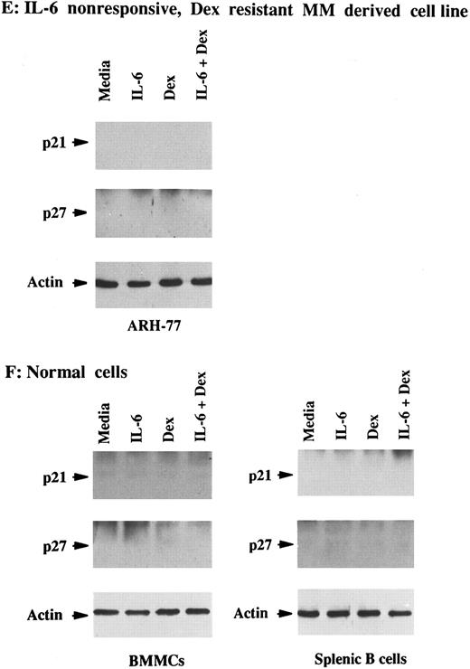 Fig. 2. Effects of Dex and/or IL-6 on p21 protein expression in MM cell lines and patient MM cells. Cells (2 × 105/mL) from IL-6–responsive MM-derived cell lines (OCI-My5, S6B45, and U-266; A) and IL-6–nonresponsive MM cell lines (HS Sultan and RPMI-8226) and JKB ALL cell line (B); 1 × 106/mL IL-6–responsive patient MM cells (patients no. 1, 3, and 5; C) and IL-6–nonresponsive patient MM cells (patients no. 2 and 4; D); 2 × 105/mL IL-6–nonresponsive Dex-resistant ARH-77 MM cells (E); and 1 × 106/mL normal BMMCs and splenic B cells (F ) were cultured with 10% FBS media alone, IL-6 (50 ng/mL), Dex (1 μmol/L), or Dex (1 μmol/L) and IL-6 (50 ng/mL). Total cell lysates were prepared 16 hours later and immunoprecipitated with anti-p21 or anti-p27 polyclonal Abs, followed by Western immunoblotting with anti-p21 or anti-p27 MoAbs. Immunoprecipitation and immunoblotting with anti-actin MoAb confirmed equal protein loading in cells that lacked detectable p21 and p27: ARH-77 (E) and normal BMMCs and splenic B cells (F ).