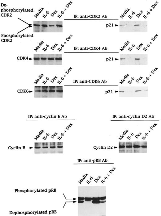 Fig. 5. Effects of Dex and/or IL-6 on expression of CDK2, CDK4, and CDK6; binding of p21 to CDK2, CDK4, and CDK6; expression of cyclin E and D2; and phosphorylation of RB in OCI-My5 MM cells. Total cells lysates were prepared from OCI-My5 MM cells cultured with media alone, IL-6 (50 ng/mL), Dex (1 μmol/L), or IL-6 (50 ng/mL) + Dex (1 μmol/L) for 16 hours. Lysates were immunoprecipitated with anti-CDK2, anti-CDK4, or anti-CDK6 polyclonal antibodies followed by Western immunoblotting with either the same antibodies or anti-p21 MoAb. Expression of cyclin E, cyclin D2, and pRB were analyzed by immunoprecipitation and Western immunoblotting using the same cell lysates.