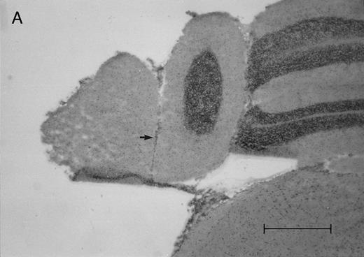 Fig. 2. Histologic progression of leukemic meningitis. All sections are 12-μm coronal sections. (A) Cisterna magna at 14 days postinjection showing a small cluster of HPB-ALL cells (arrow) in the subarachnoid space, H&E, bar = 0.64 mm. (B) Cisterna magna at 21 days postinjection showing large groups of HPB-ALL cells in the subarachnoid space (arrow), H&E, bar = 0.64 mm. Compare the large groups of cells shown here with the small cluster at 14 days postinjection shown in (A). / (C and D) Cerebral level of the animal shown in (B), showing a very small cluster of HPB-ALL cells in the subarachnoid space (arrow), H&E (C), and leukocyte common antigen (LCA) (D), bar = 0.09 mm. Compare the sparse leukemic cell density here with the posterior fossa section in (B). / (E) Cerebral level of an animal that died during the natural progression of the disease. Note the extensive replacement of the subarachnoid space of the interhemispheric fissure by HPB-ALL cells and the invasion of Virchow-Robin spaces, H&E, bar = 0.56 mm.