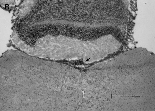 Fig. 2. Histologic progression of leukemic meningitis. All sections are 12-μm coronal sections. (A) Cisterna magna at 14 days postinjection showing a small cluster of HPB-ALL cells (arrow) in the subarachnoid space, H&E, bar = 0.64 mm. (B) Cisterna magna at 21 days postinjection showing large groups of HPB-ALL cells in the subarachnoid space (arrow), H&E, bar = 0.64 mm. Compare the large groups of cells shown here with the small cluster at 14 days postinjection shown in (A). / (C and D) Cerebral level of the animal shown in (B), showing a very small cluster of HPB-ALL cells in the subarachnoid space (arrow), H&E (C), and leukocyte common antigen (LCA) (D), bar = 0.09 mm. Compare the sparse leukemic cell density here with the posterior fossa section in (B). / (E) Cerebral level of an animal that died during the natural progression of the disease. Note the extensive replacement of the subarachnoid space of the interhemispheric fissure by HPB-ALL cells and the invasion of Virchow-Robin spaces, H&E, bar = 0.56 mm.
