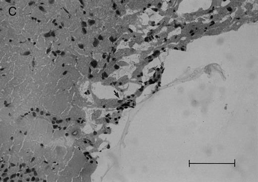 Fig. 2. Histologic progression of leukemic meningitis. All sections are 12-μm coronal sections. (A) Cisterna magna at 14 days postinjection showing a small cluster of HPB-ALL cells (arrow) in the subarachnoid space, H&E, bar = 0.64 mm. (B) Cisterna magna at 21 days postinjection showing large groups of HPB-ALL cells in the subarachnoid space (arrow), H&E, bar = 0.64 mm. Compare the large groups of cells shown here with the small cluster at 14 days postinjection shown in (A). / (C and D) Cerebral level of the animal shown in (B), showing a very small cluster of HPB-ALL cells in the subarachnoid space (arrow), H&E (C), and leukocyte common antigen (LCA) (D), bar = 0.09 mm. Compare the sparse leukemic cell density here with the posterior fossa section in (B). / (E) Cerebral level of an animal that died during the natural progression of the disease. Note the extensive replacement of the subarachnoid space of the interhemispheric fissure by HPB-ALL cells and the invasion of Virchow-Robin spaces, H&E, bar = 0.56 mm.