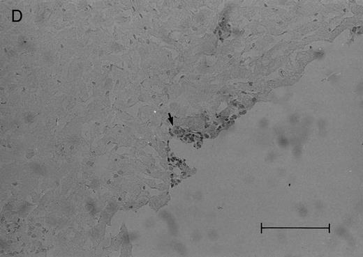 Fig. 2. Histologic progression of leukemic meningitis. All sections are 12-μm coronal sections. (A) Cisterna magna at 14 days postinjection showing a small cluster of HPB-ALL cells (arrow) in the subarachnoid space, H&E, bar = 0.64 mm. (B) Cisterna magna at 21 days postinjection showing large groups of HPB-ALL cells in the subarachnoid space (arrow), H&E, bar = 0.64 mm. Compare the large groups of cells shown here with the small cluster at 14 days postinjection shown in (A). / (C and D) Cerebral level of the animal shown in (B), showing a very small cluster of HPB-ALL cells in the subarachnoid space (arrow), H&E (C), and leukocyte common antigen (LCA) (D), bar = 0.09 mm. Compare the sparse leukemic cell density here with the posterior fossa section in (B). / (E) Cerebral level of an animal that died during the natural progression of the disease. Note the extensive replacement of the subarachnoid space of the interhemispheric fissure by HPB-ALL cells and the invasion of Virchow-Robin spaces, H&E, bar = 0.56 mm.