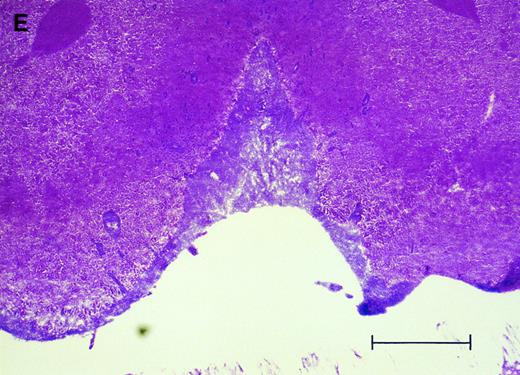 Fig. 2. Histologic progression of leukemic meningitis. All sections are 12-μm coronal sections. (A) Cisterna magna at 14 days postinjection showing a small cluster of HPB-ALL cells (arrow) in the subarachnoid space, H&E, bar = 0.64 mm. (B) Cisterna magna at 21 days postinjection showing large groups of HPB-ALL cells in the subarachnoid space (arrow), H&E, bar = 0.64 mm. Compare the large groups of cells shown here with the small cluster at 14 days postinjection shown in (A). / (C and D) Cerebral level of the animal shown in (B), showing a very small cluster of HPB-ALL cells in the subarachnoid space (arrow), H&E (C), and leukocyte common antigen (LCA) (D), bar = 0.09 mm. Compare the sparse leukemic cell density here with the posterior fossa section in (B). / (E) Cerebral level of an animal that died during the natural progression of the disease. Note the extensive replacement of the subarachnoid space of the interhemispheric fissure by HPB-ALL cells and the invasion of Virchow-Robin spaces, H&E, bar = 0.56 mm.