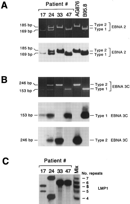 Fig. 2. EBV types and variants in lymphadenopathy lesions and lymphomas. Representative lymphadenopathy lesions harboring EBV type 1 (no. 17) or EBV types 1 and 2 (no. 24), and lymphoma lesions harboring EBV type 2 (no. 33) or EBV type 1 (no. 47) are shown in (A) and (B). The amplified EBNA2 products were visualized in ethidium bromide–stained acrylamide gels and detected with a radiolabeled probe that detects EBV types 1 and 2 (A); the amplified EBNA 3C products from the same samples were visualized in ethidium bromide–stained gels and detected using two different radiolabeled probes specific for EBV types 1 and 2, respectively (B). (C) LMP1 variant analysis of the same lesions. Two different LMP1 variants were detected in each lymphadenopathy lesion, while a single LMP1 variant was detected in lymphoma samples. Lane “mix” contained a mixture of five amplified LMP1 products, containing 4, 5, 6, or 7 repeats, or 5 repeats (5) with the 15-bp insertion.