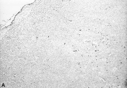 Fig. 3. In situ hybridization with EBER probes. In a representative lymphadenopathy case (no. 20), rare EBER+ cells are seen, mainly in the interfollicular areas (A and B). In a representative lymphoma case (no. 46) nearly half of the cells are EBER+ (C and D). Original magnification: ×130 (A and C) and ×260 (B and D).