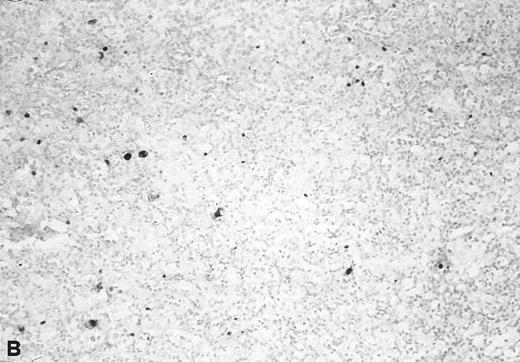 Fig. 3. In situ hybridization with EBER probes. In a representative lymphadenopathy case (no. 20), rare EBER+ cells are seen, mainly in the interfollicular areas (A and B). In a representative lymphoma case (no. 46) nearly half of the cells are EBER+ (C and D). Original magnification: ×130 (A and C) and ×260 (B and D).