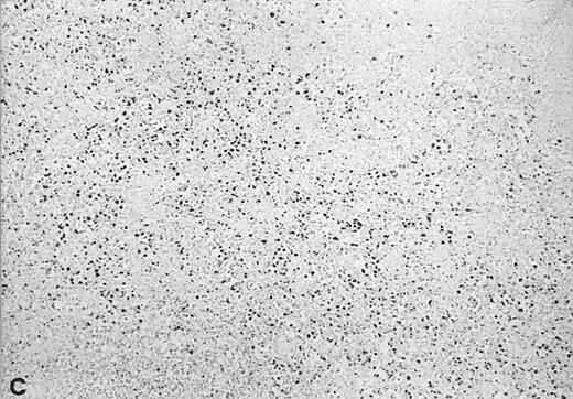 Fig. 3. In situ hybridization with EBER probes. In a representative lymphadenopathy case (no. 20), rare EBER+ cells are seen, mainly in the interfollicular areas (A and B). In a representative lymphoma case (no. 46) nearly half of the cells are EBER+ (C and D). Original magnification: ×130 (A and C) and ×260 (B and D).