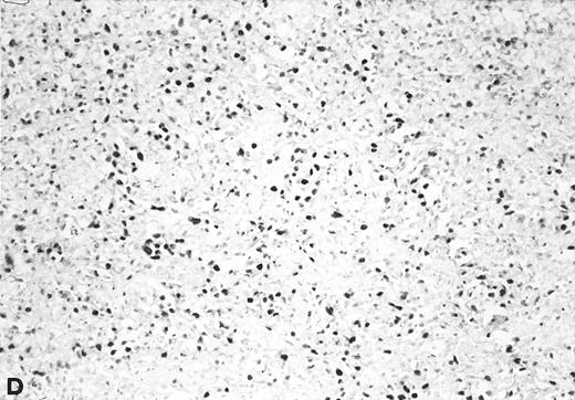 Fig. 3. In situ hybridization with EBER probes. In a representative lymphadenopathy case (no. 20), rare EBER+ cells are seen, mainly in the interfollicular areas (A and B). In a representative lymphoma case (no. 46) nearly half of the cells are EBER+ (C and D). Original magnification: ×130 (A and C) and ×260 (B and D).