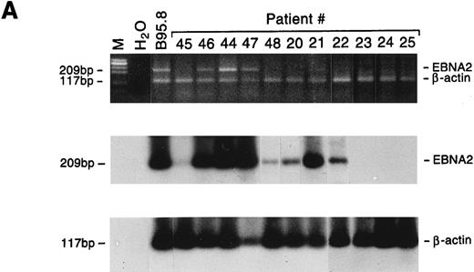 Fig. 5. Detection of EBNA2 and LMP1 transcripts in lymphadenopathy lesions and lymphomas. Multiplex-PCR was performed using primers specific for the β-actin gene and either EBNA2 (A) or LMP1 gene (B); the amplified products of 117 bp, 209 bp, and 296 bp, respectively, were stained with ethidium bromide and hybridized with probes specific for EBNA2 or LMP1 and β-actin genes. M, molecular-weight marker φx 174/HaeIII.
