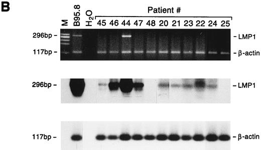 Fig. 5. Detection of EBNA2 and LMP1 transcripts in lymphadenopathy lesions and lymphomas. Multiplex-PCR was performed using primers specific for the β-actin gene and either EBNA2 (A) or LMP1 gene (B); the amplified products of 117 bp, 209 bp, and 296 bp, respectively, were stained with ethidium bromide and hybridized with probes specific for EBNA2 or LMP1 and β-actin genes. M, molecular-weight marker φx 174/HaeIII.